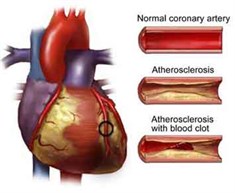 FH Heart Diagram