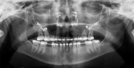 X Ray Upper Jaw