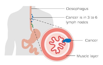 Oesophago-gastric Surgery Team