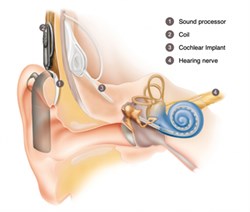 Cochlear Implant Pic